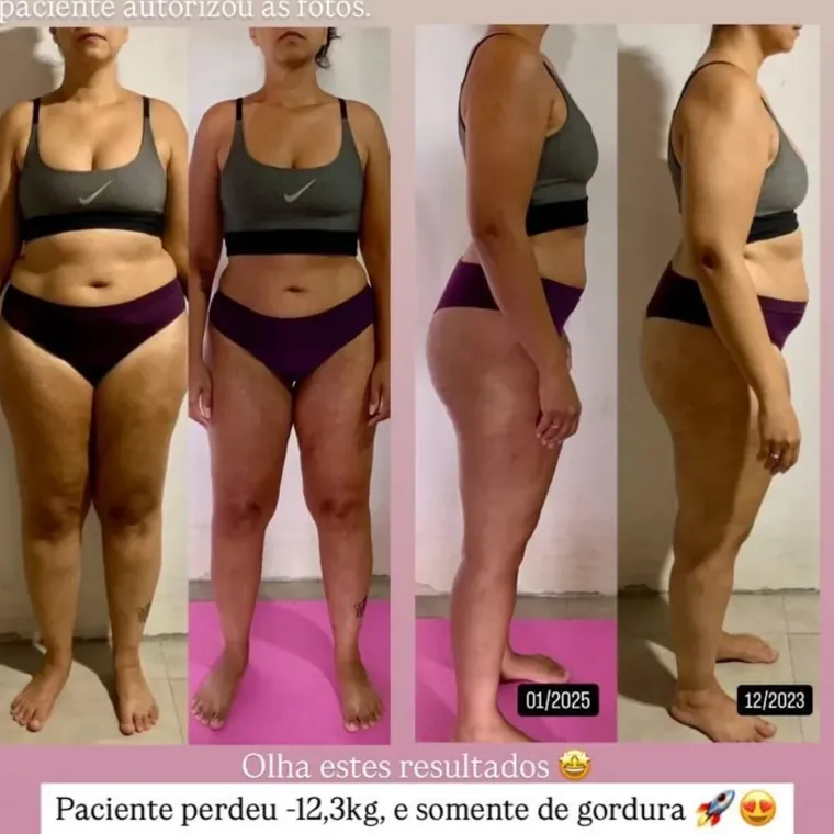 Resultado real de paciente, fotos autorizadas
